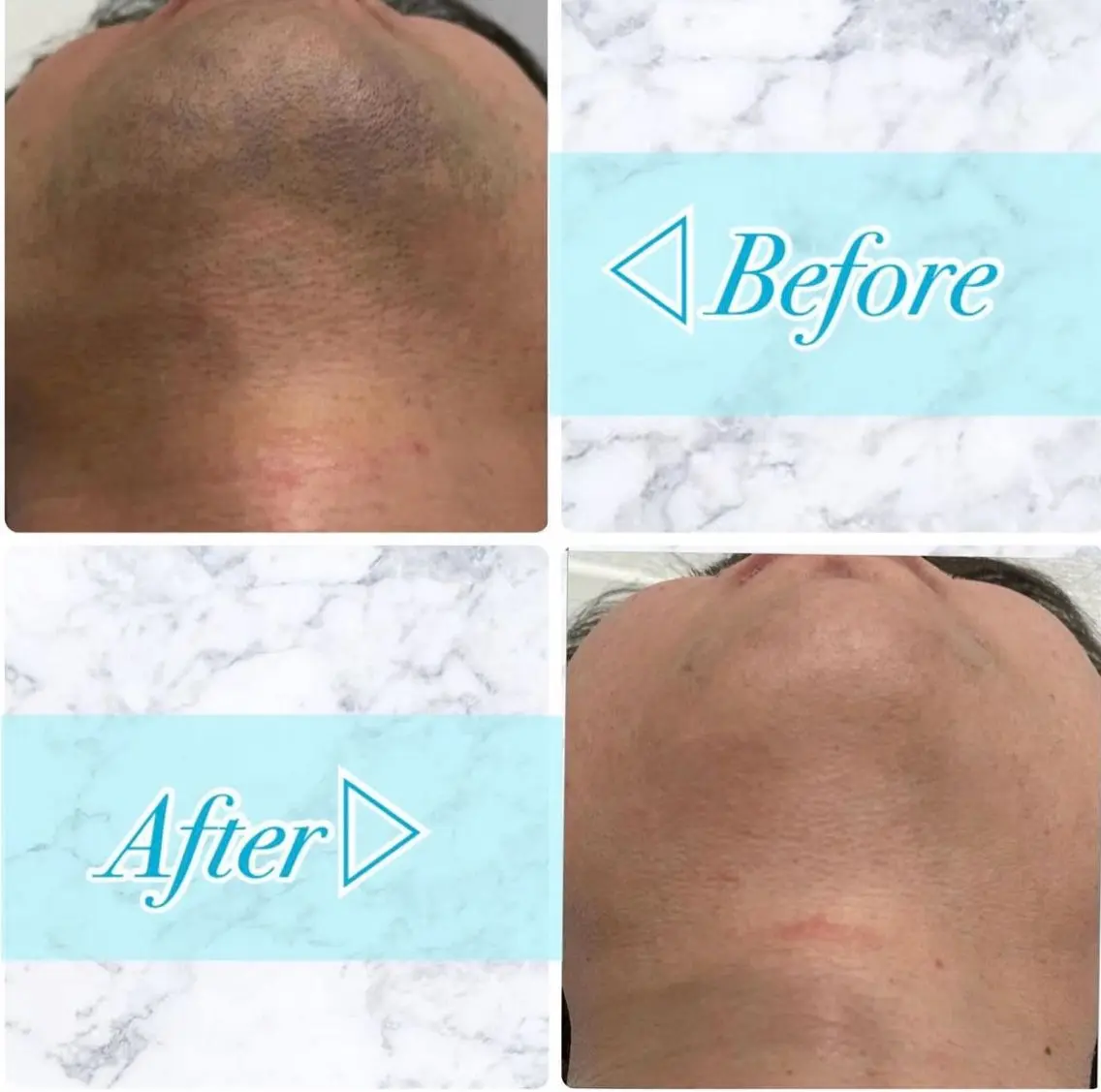 先着5名様!!【1回で抜ける】ヒゲ★ハイスペック脱毛¥3600の写真