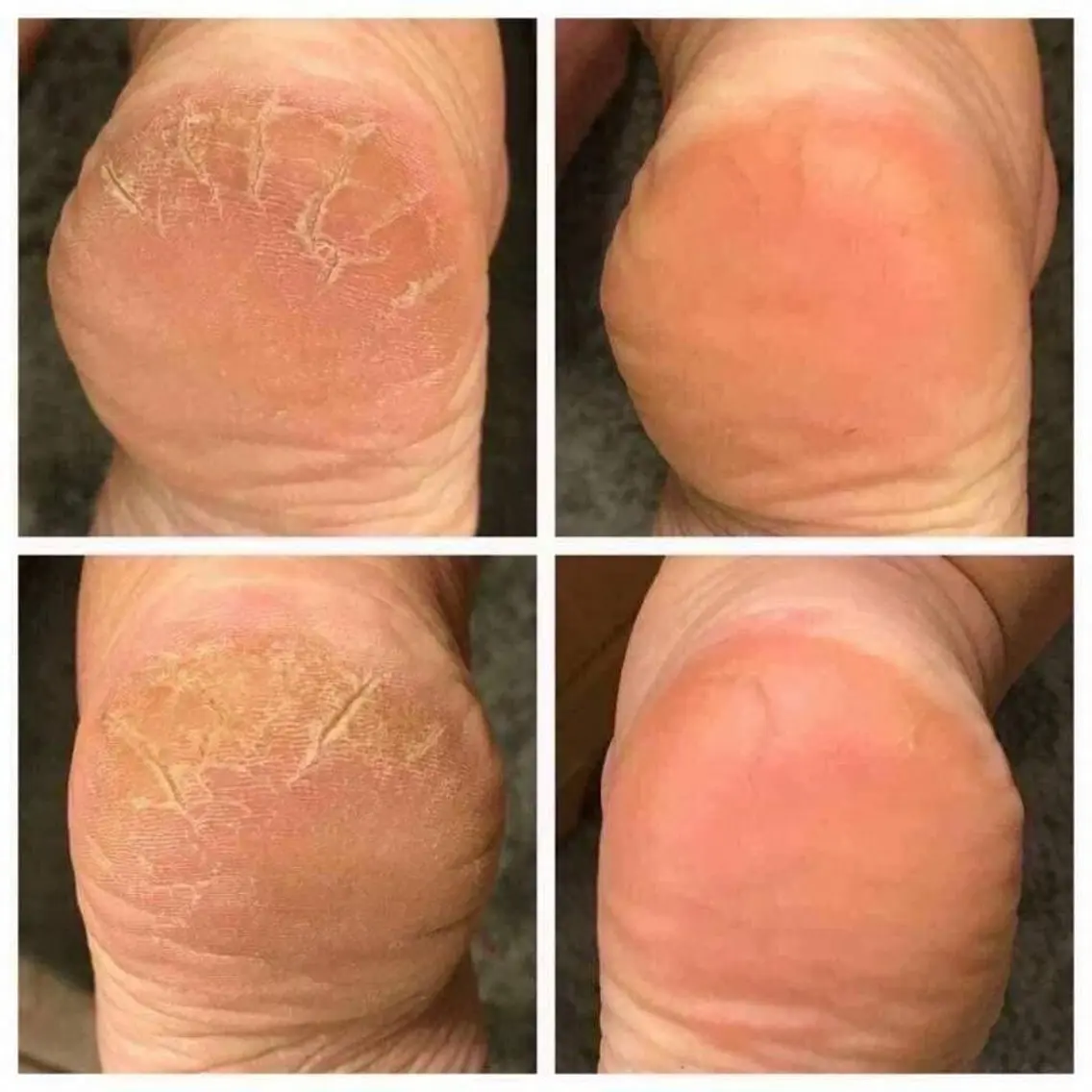 フットの角質ケアの写真