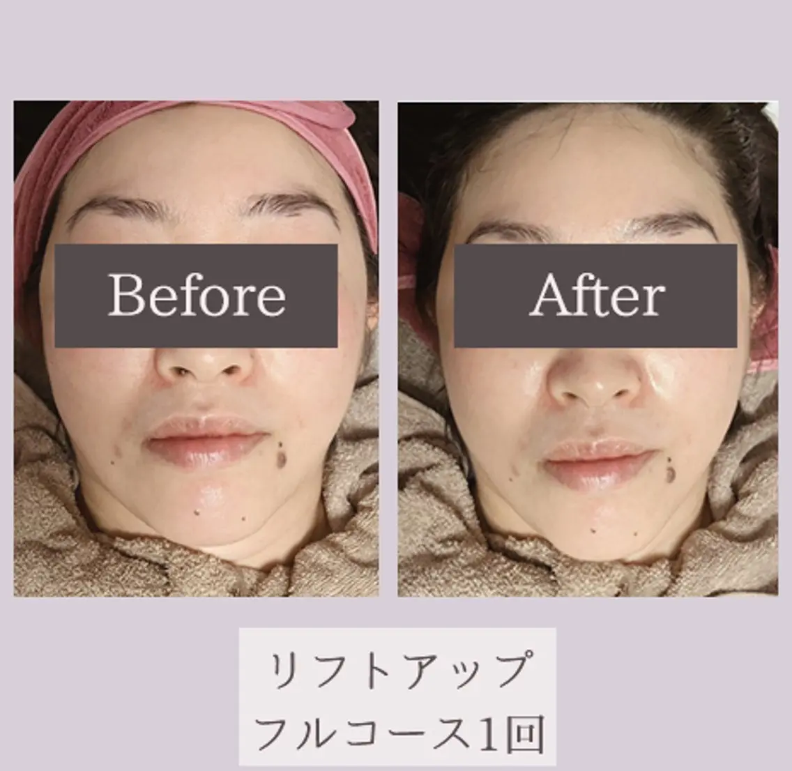 リフトアップフルコース❣️話題のサーマトリックスの効果をぜひお試し下さい🌟の写真
