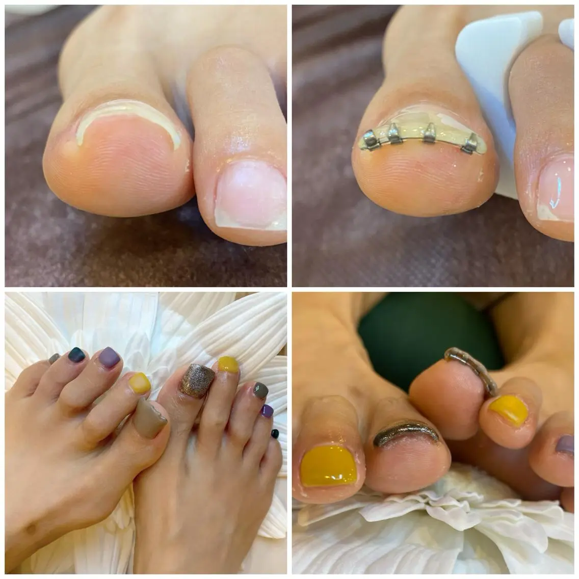 ネイル ♢ME2ROOM♢ #巻き爪#リラクのネイルデザイン