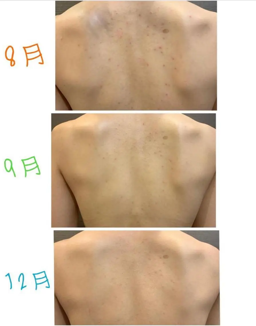 背中ニキビ、ニキビ跡ケア✨の写真