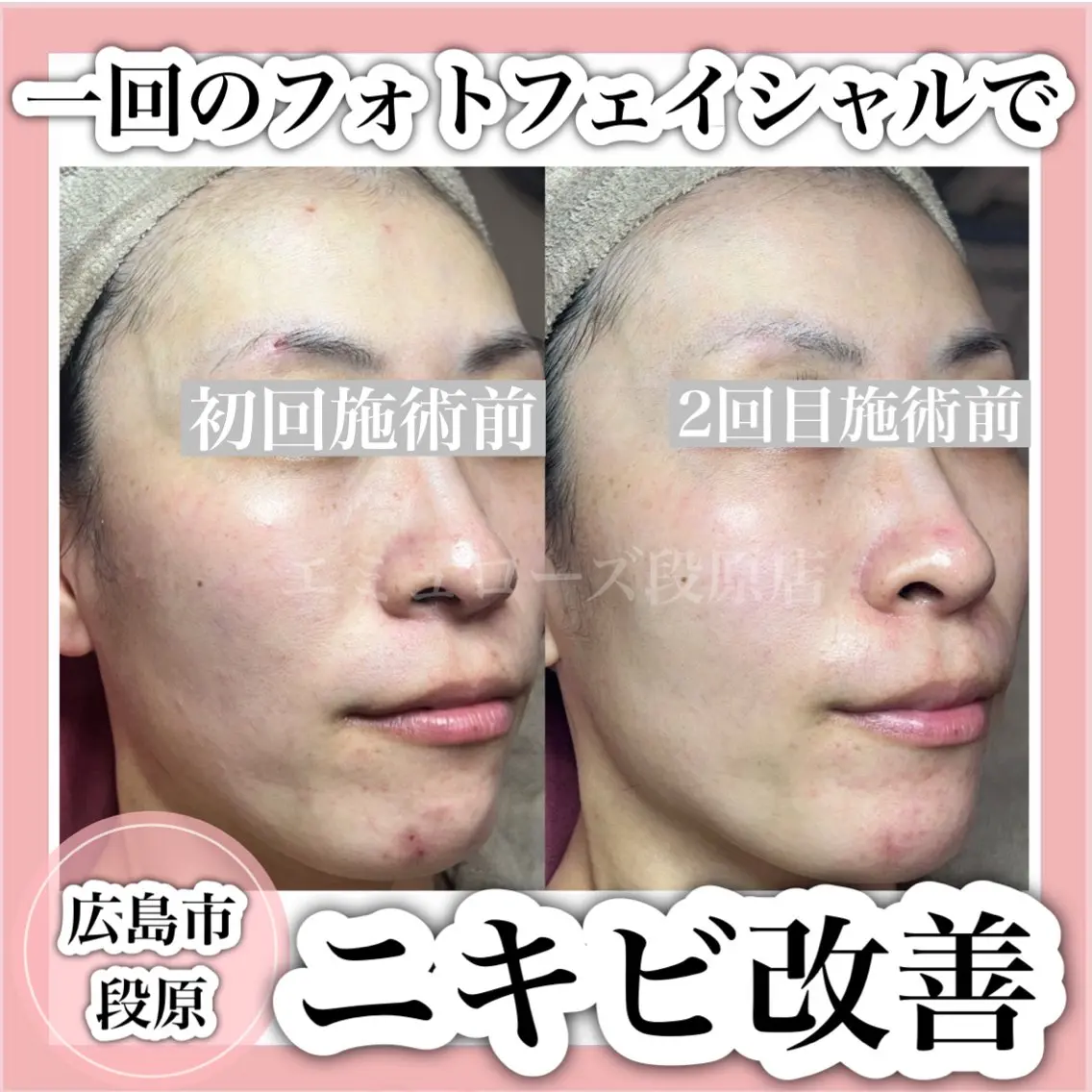《凸凹肌・毛穴の開き・ニキビケアでお悩みの方》光フェイシャルの写真