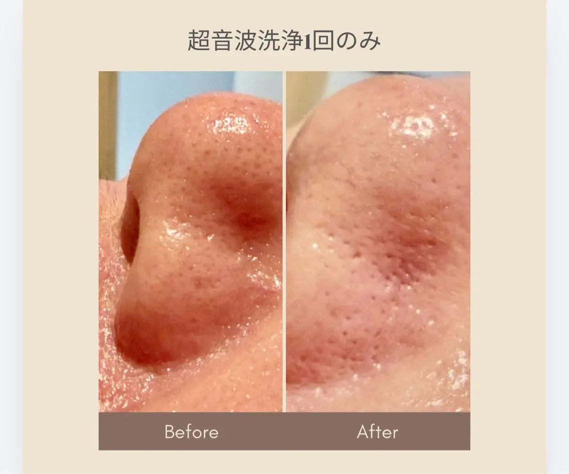 超音波洗浄毛穴ツルツルの写真