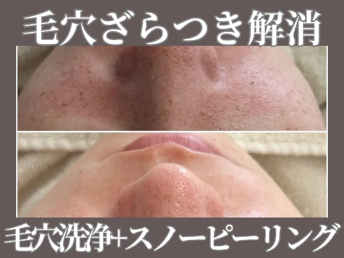 【長年の黒ずみ悩みに】角栓/皮脂詰まり 毛穴洗浄+白玉ピーリングの写真