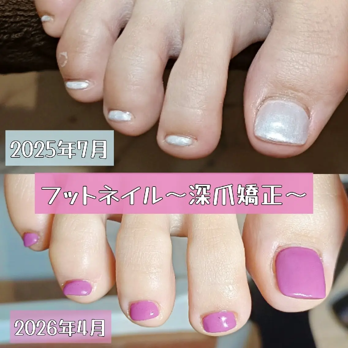ネイル フットネイル 深爪矯正/爪育成ケア manie nailのネイルデザイン