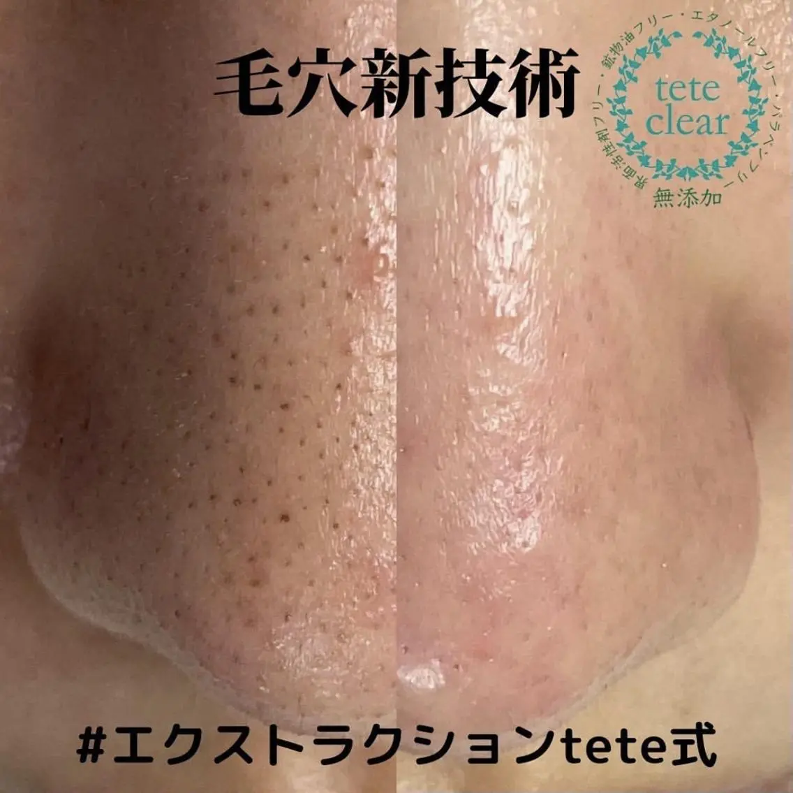 思わず触りたくなるほどピカピカに★まるごと全顔エクストラクション＋光脱毛の写真
