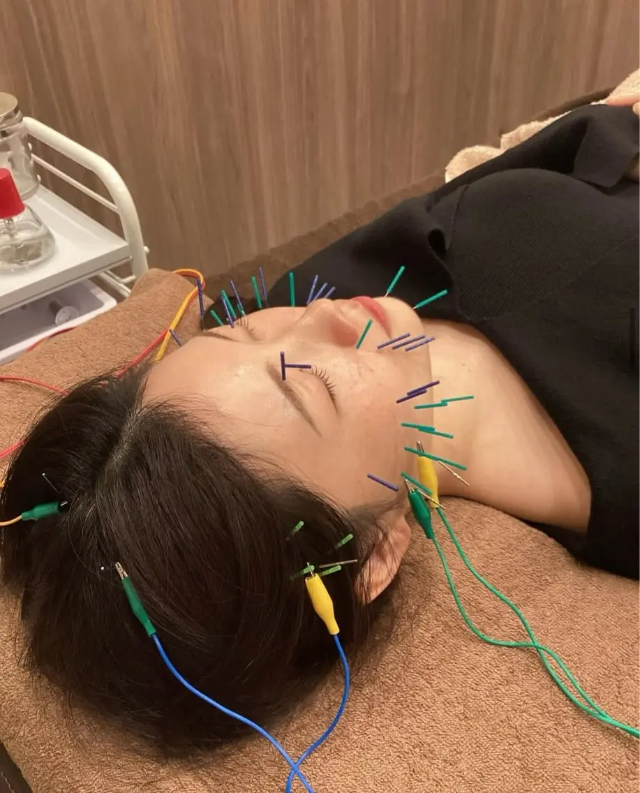 🪡🇰🇷BASIC美容鍼✖️LHALA PEEL:ララピールの写真
