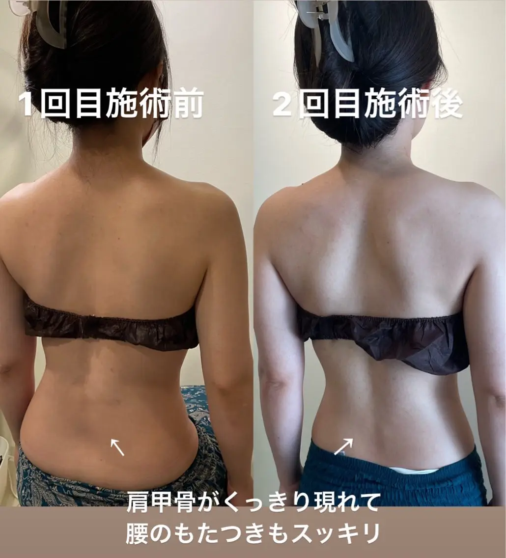 背中が変わるとスルスル痩せる背中深層リンパマッサージ。背中痩せ二の腕痩せ 変化が凄い!ブライダルエステの写真