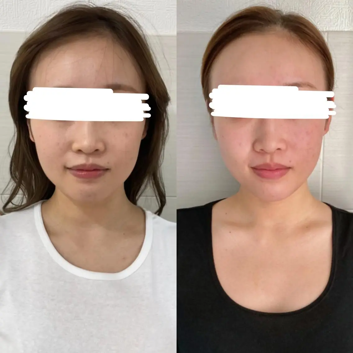 ✨ミニモ学割✨【小顔矯正+骨盤矯正+頭蓋骨矯正】骨格美容矯正❗肩幅矯正/ボディケア/左右差/巻き肩/二の腕/男性スタッフの写真
