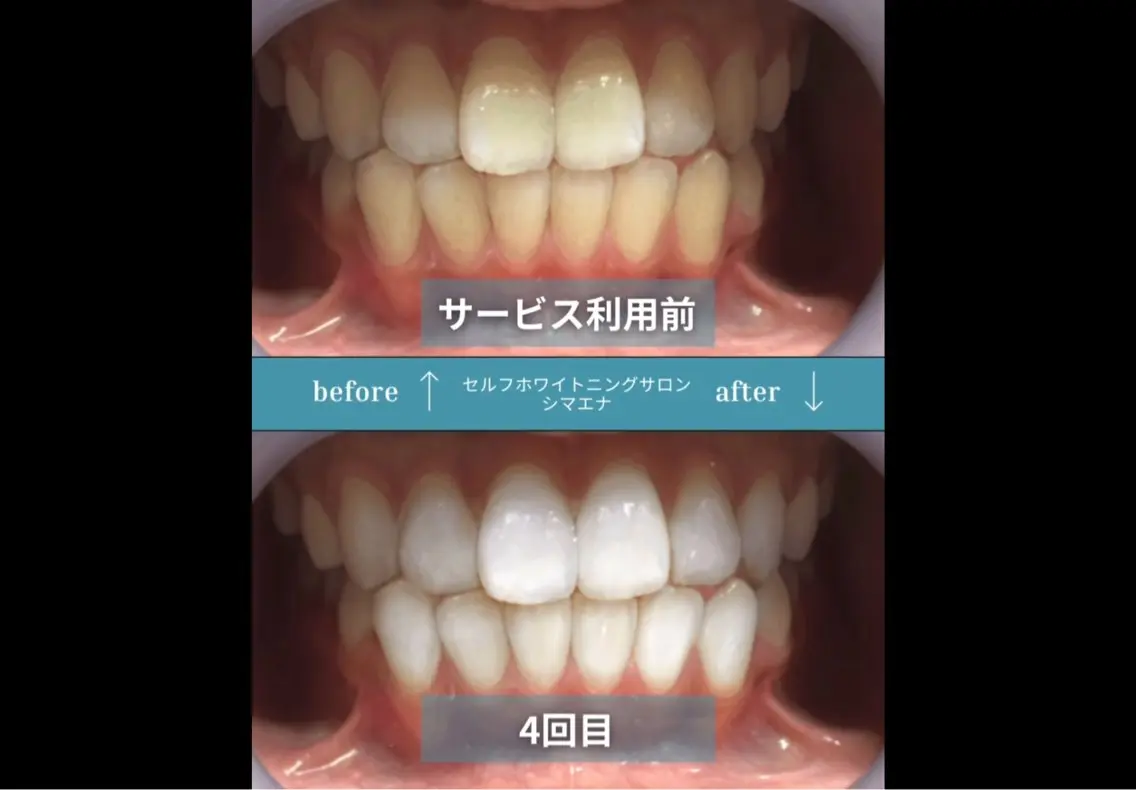 セルフホワイトニング シマエナのその他イメージ
