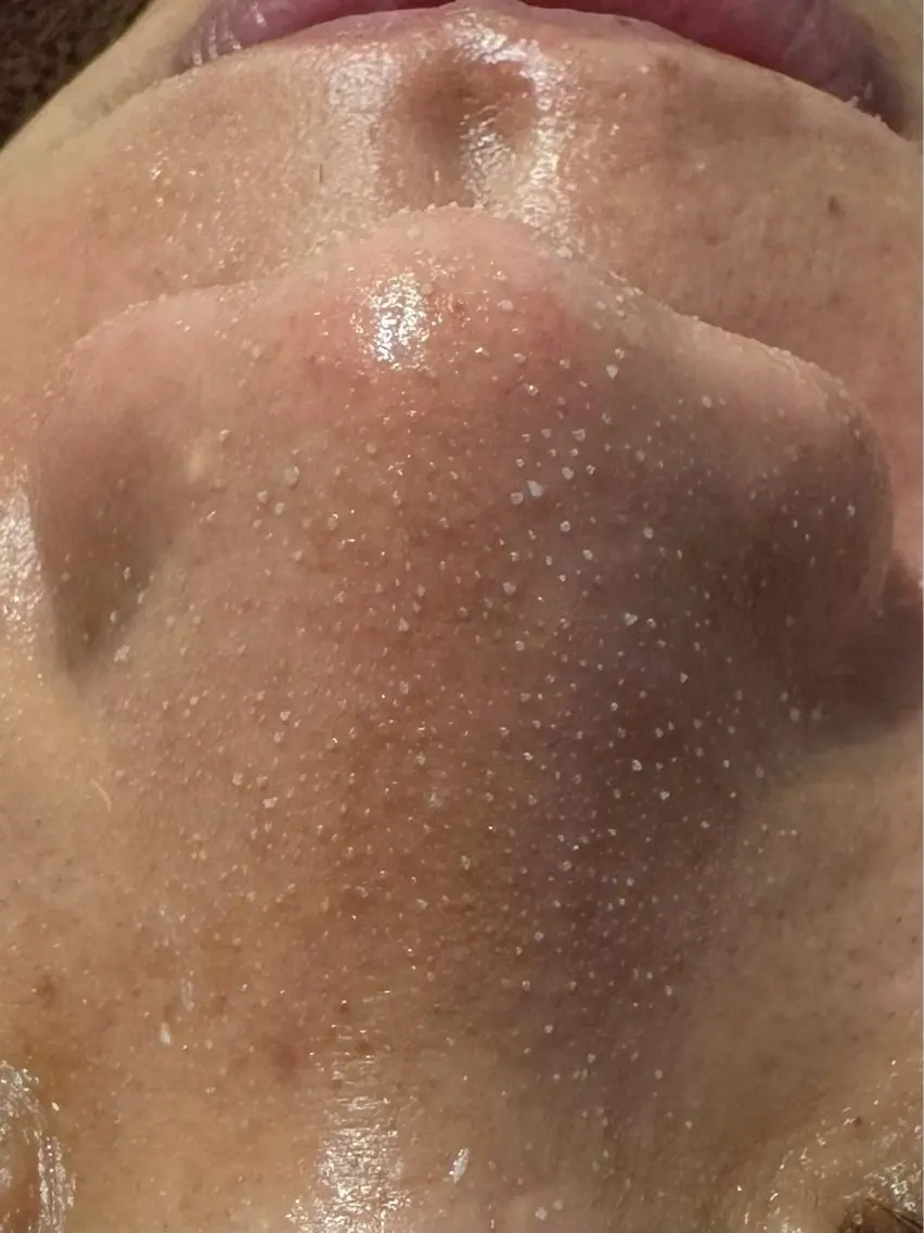 鼻のみ毛穴洗浄の写真