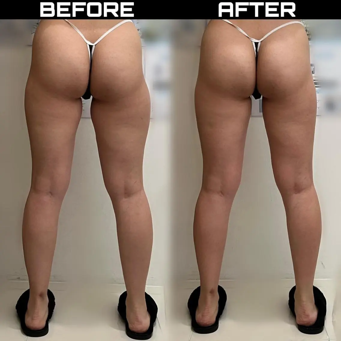 【BODY SHAPE🦵】下半身集中プラン｜太もも・ふくらはぎ・ヒップ特化の構造アプローチ◎初回体験OK✨の写真