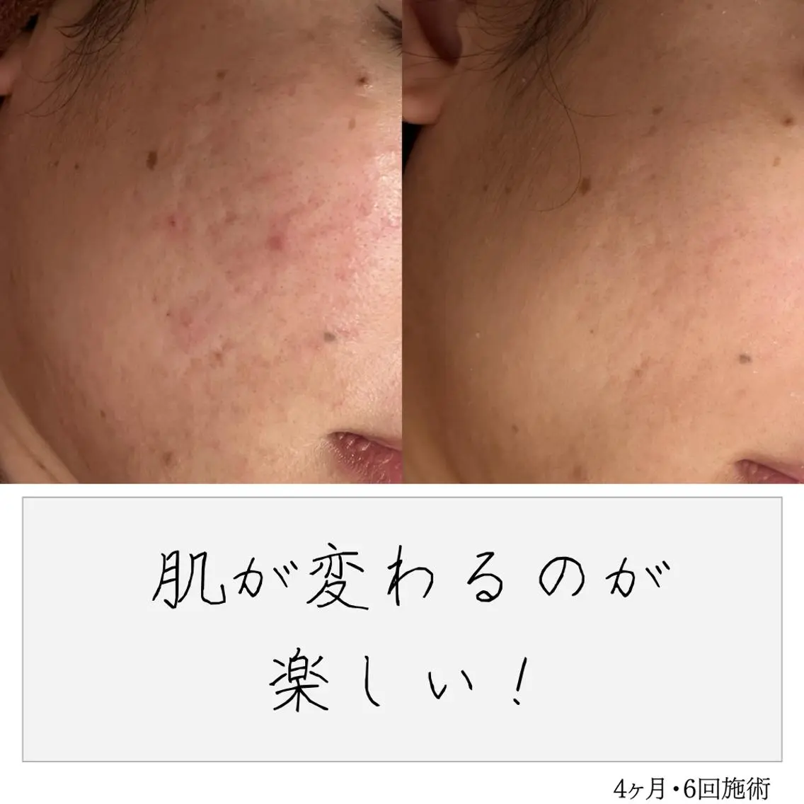 ニキビ経験者が施術 する専門サロン🌻のエステ・リラクイメージ