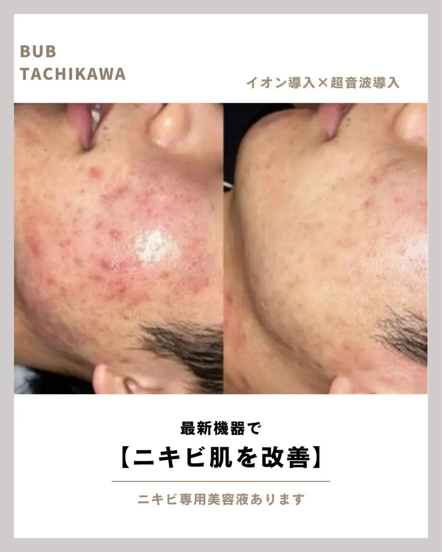 【ニキビ肌を即日鎮静】皮膚科推奨成分×高濃度美容液ケア|赤み・炎症・跡まで根本改善の写真