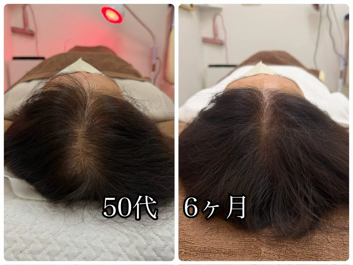 はりひろし式鬼育毛鍼/AGA/FAGA/多発性円形脱毛症などの写真