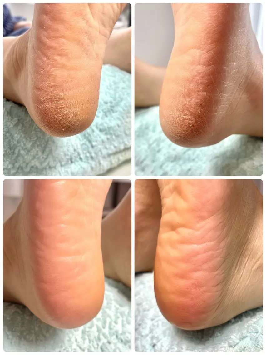フット 角質ケアの写真