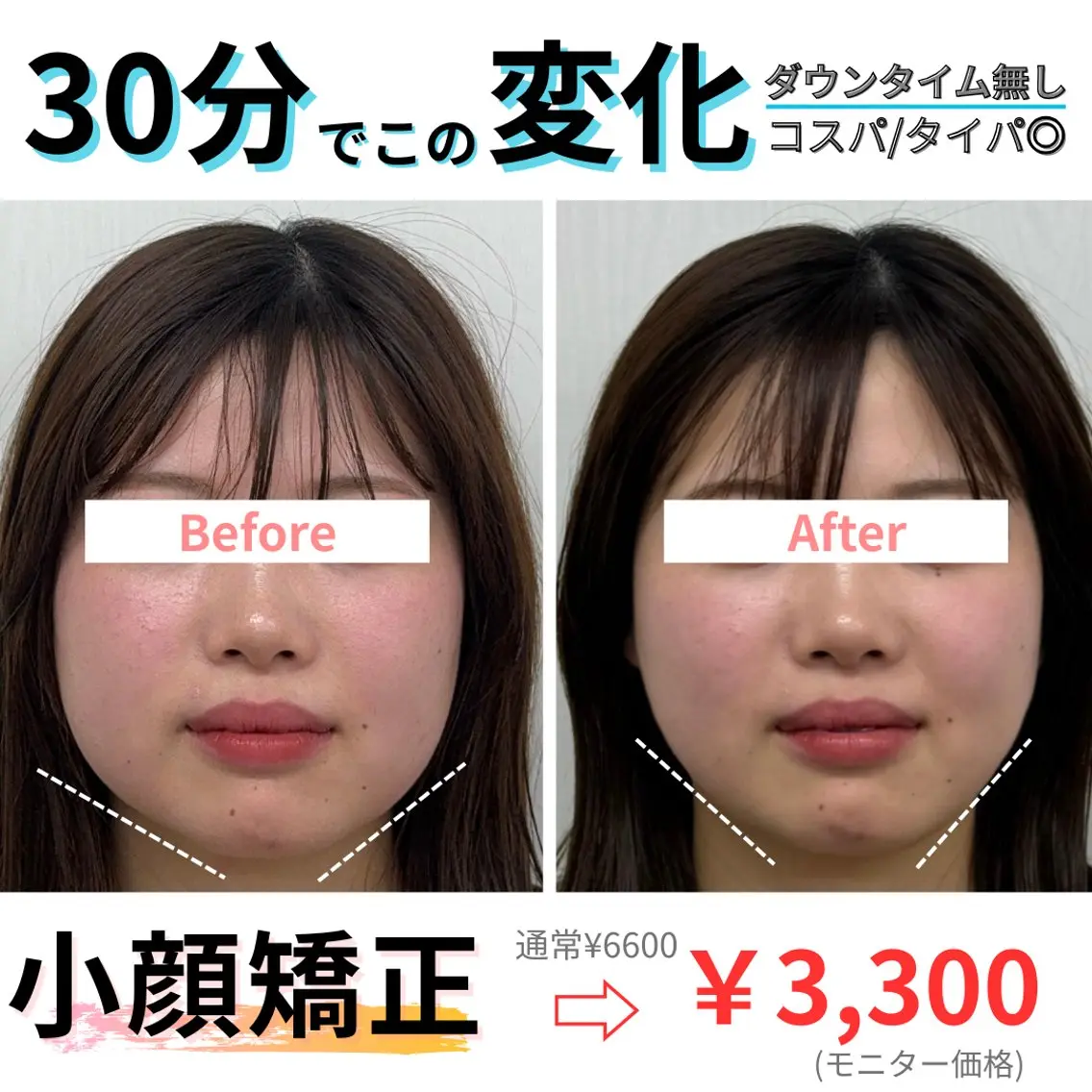 【🌟minimo限定🌟】小顔矯正6600→4400の写真