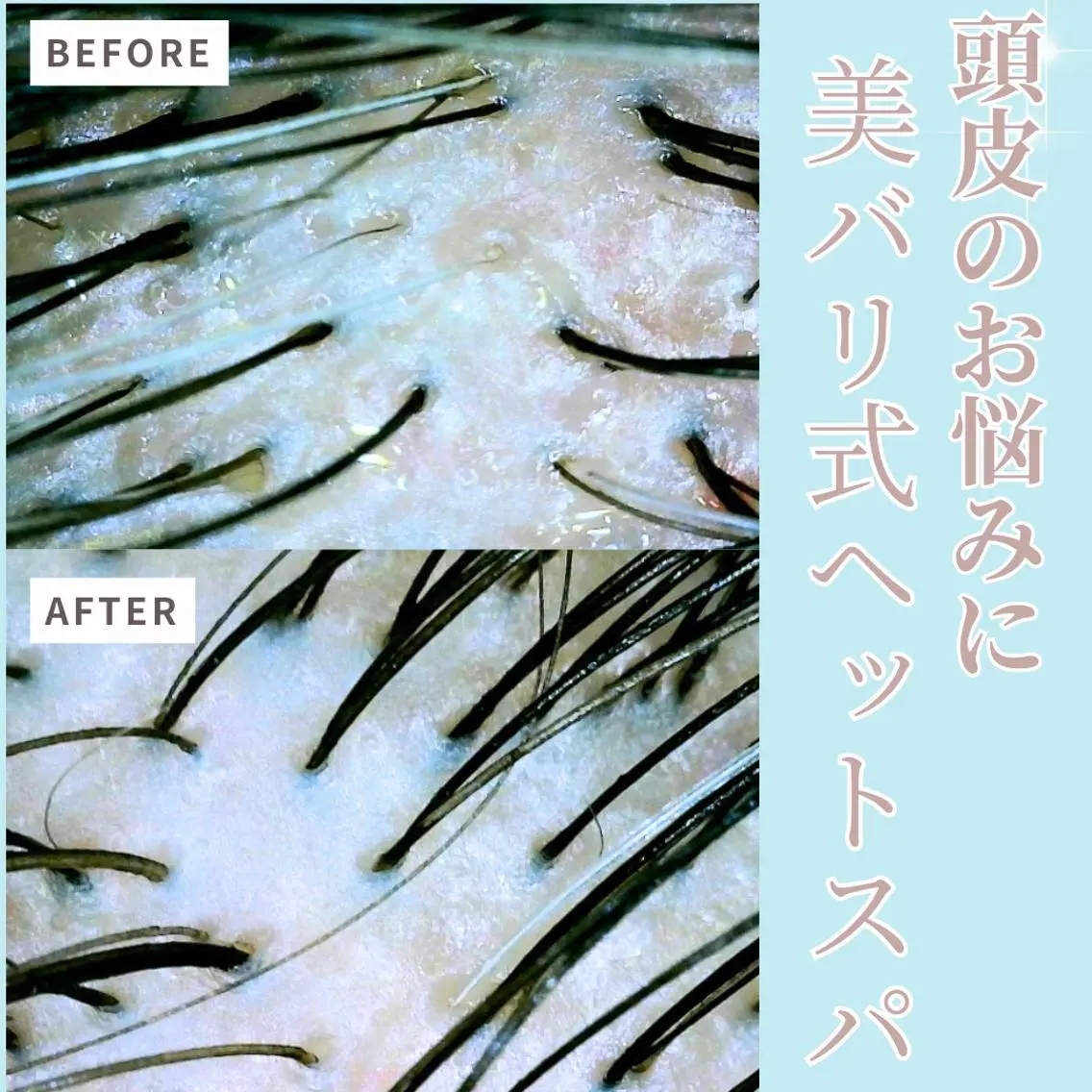 🌿発根セラピーヘッドスパ🌿 EMS × エアバリ \ふんわり美髪を育てる頭皮ケアコース✨/の写真