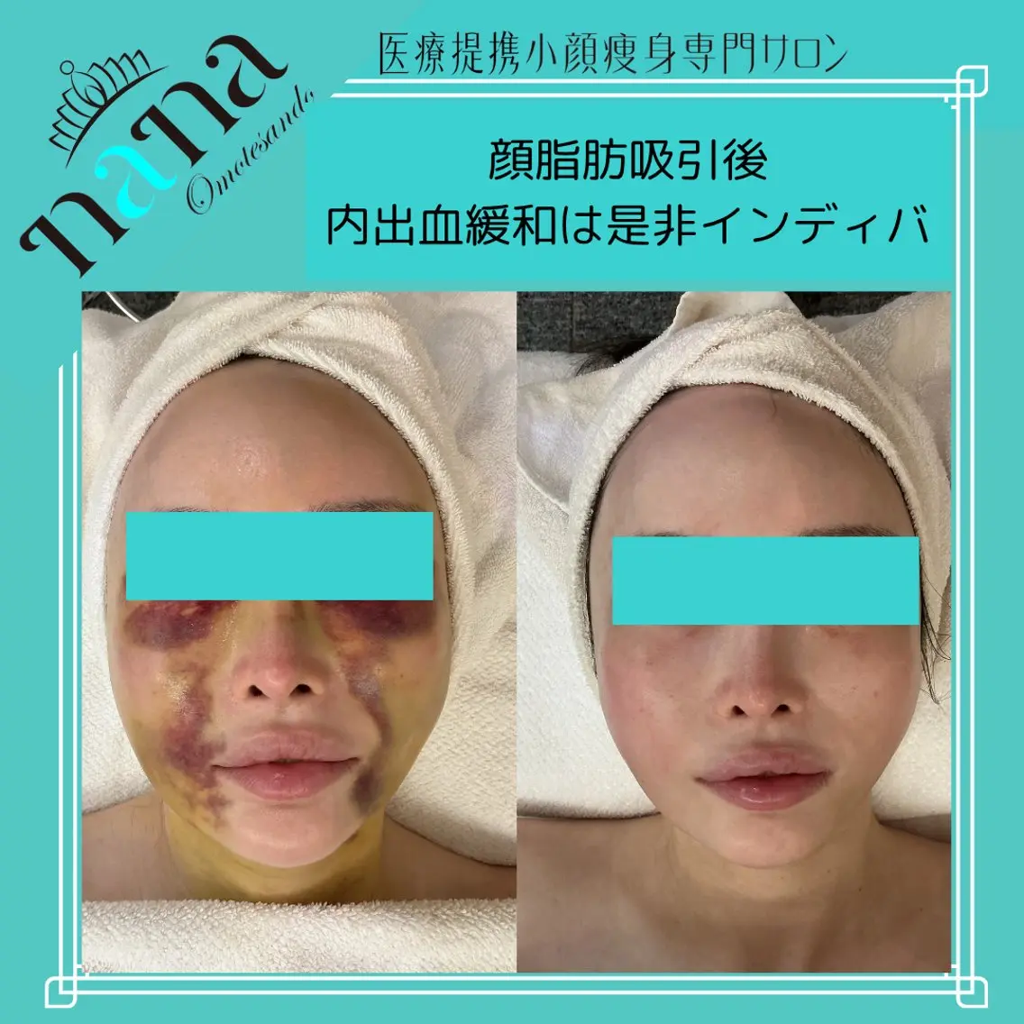 【美容施術前&後】フェイスライン・むくみ・こわばりを丁寧にケアする高周波お顔/顎下/首/デコルテ◎60分集中コースの写真