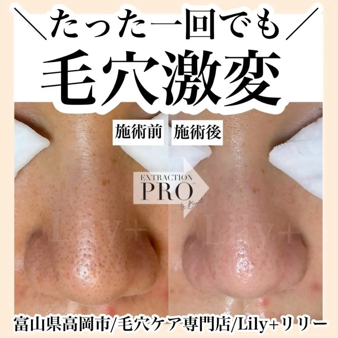 毛穴エステの写真