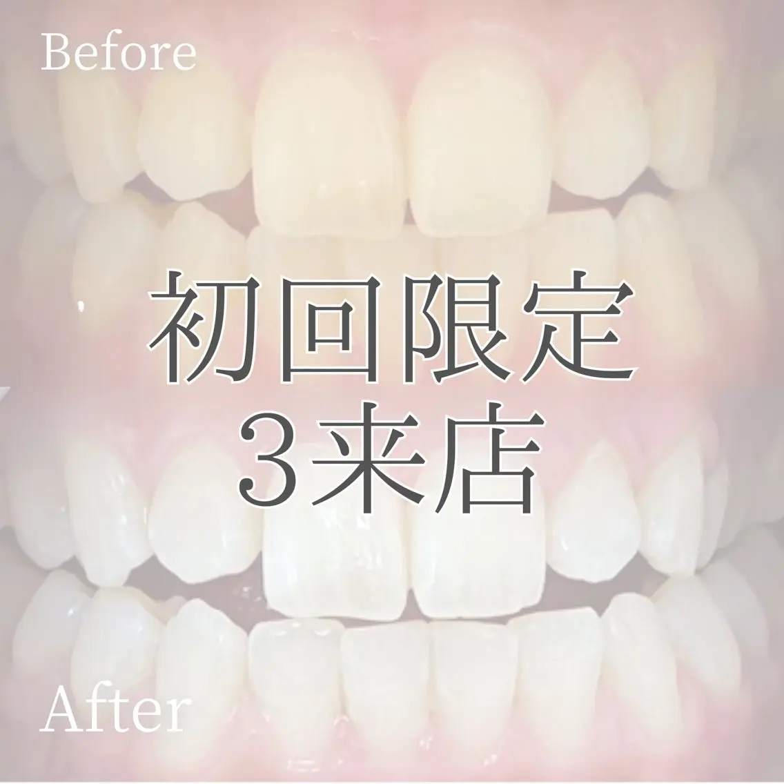 【ミニモ限定✨】3来店チケット通常¥20,940→¥12,000👀ホワイトニングの良さを知ってください❗️の写真