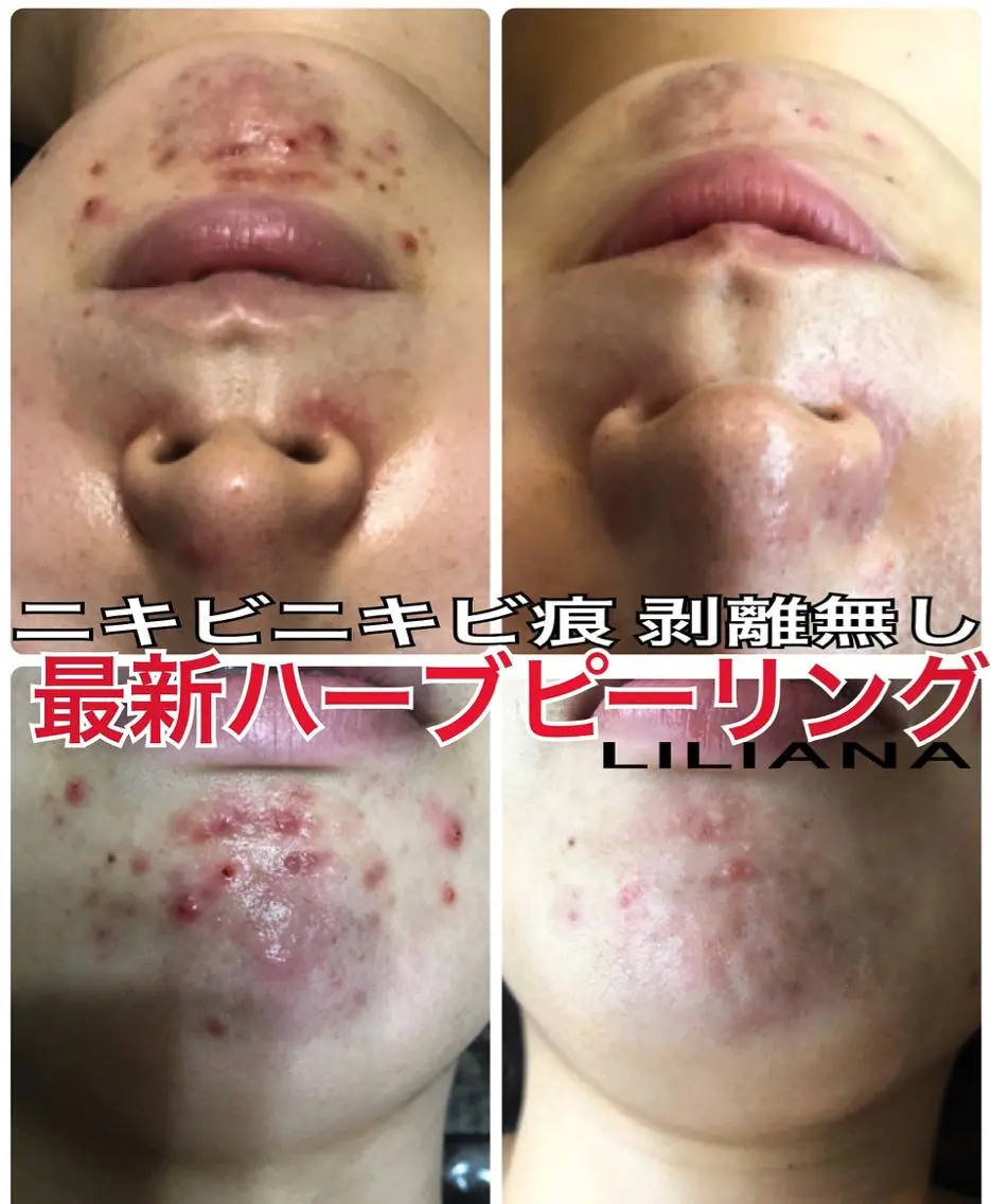 ニキビ・ニキビ跡おススメ⭐️【剥離無し】 REVI🌹ハーブピーリング 🌹 陶肌パウダー・酵素300種・高濃度ビタミンの写真