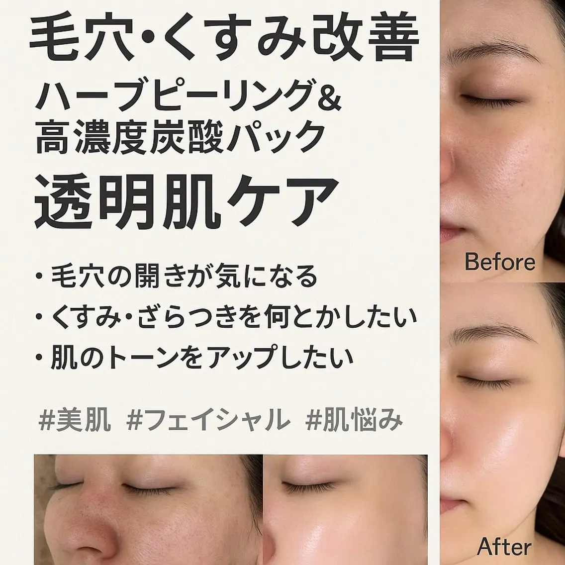 【ニキビ撲滅】剥離なしハーブピーリング×高濃度炭酸|繰り返す荒れ肌を根本改善。「一生モノ」の陶器肌へ【施術60分】の写真