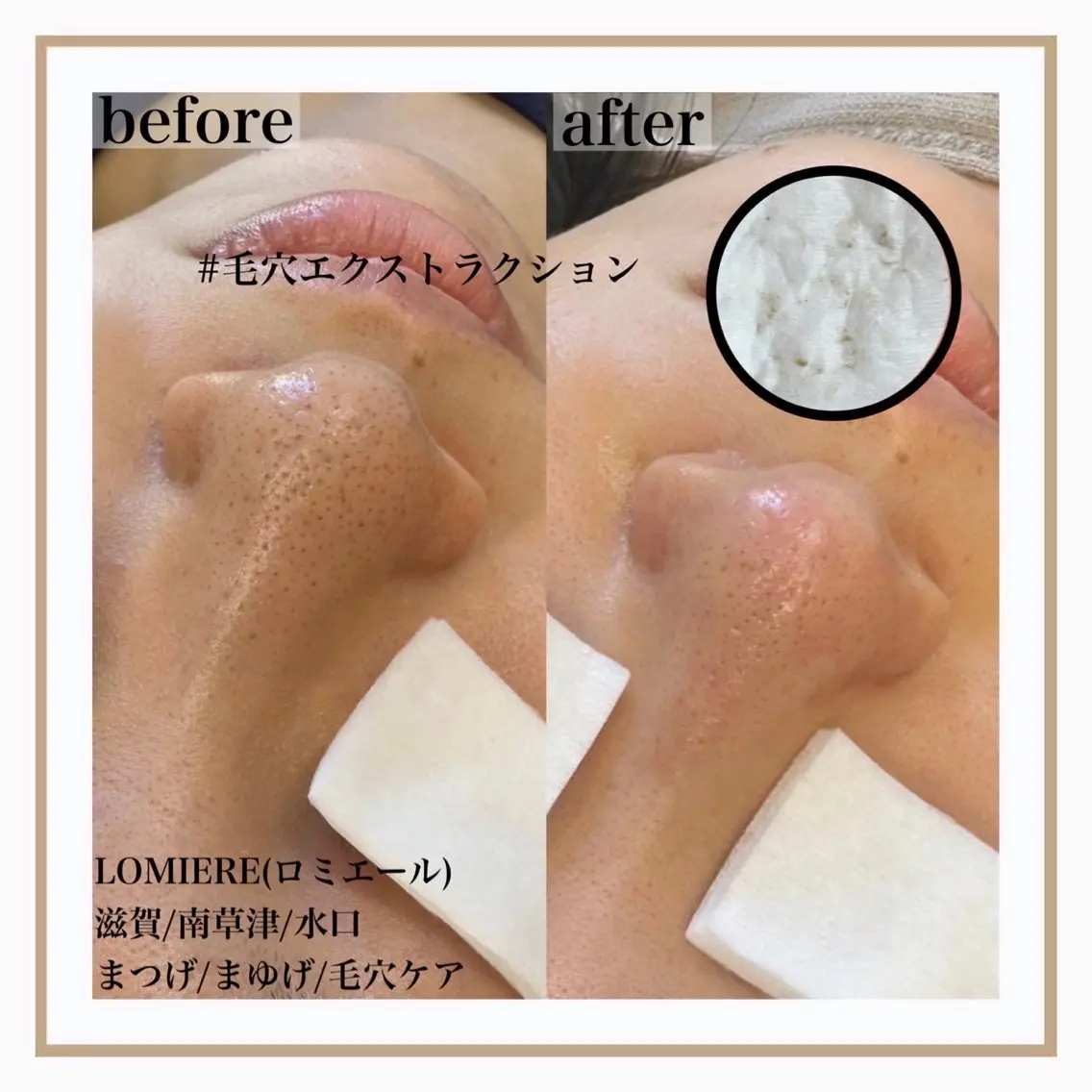 毛穴エクストラクションの写真