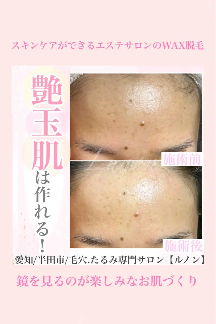 肌質改善スキンケアWAX脱毛の写真