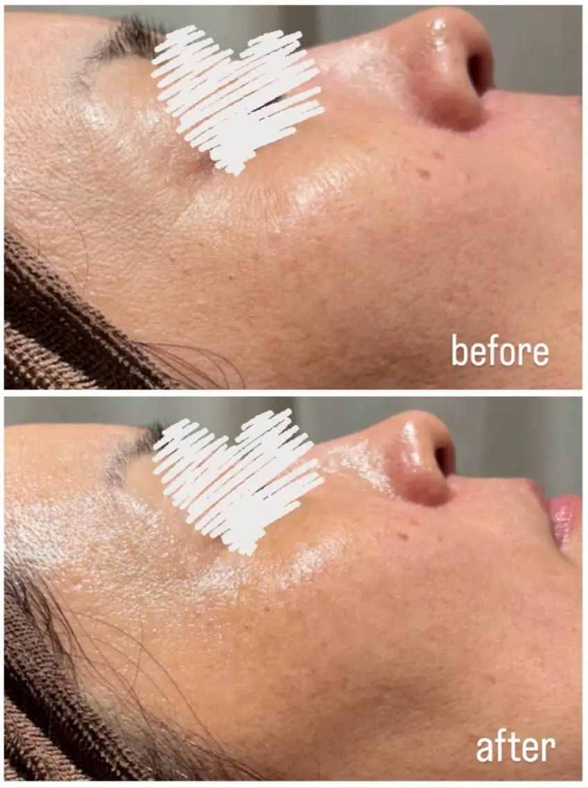【30代​〜​向け🌼】毛穴洗浄×エイジングケア💆🏻‍♀️✨️の写真