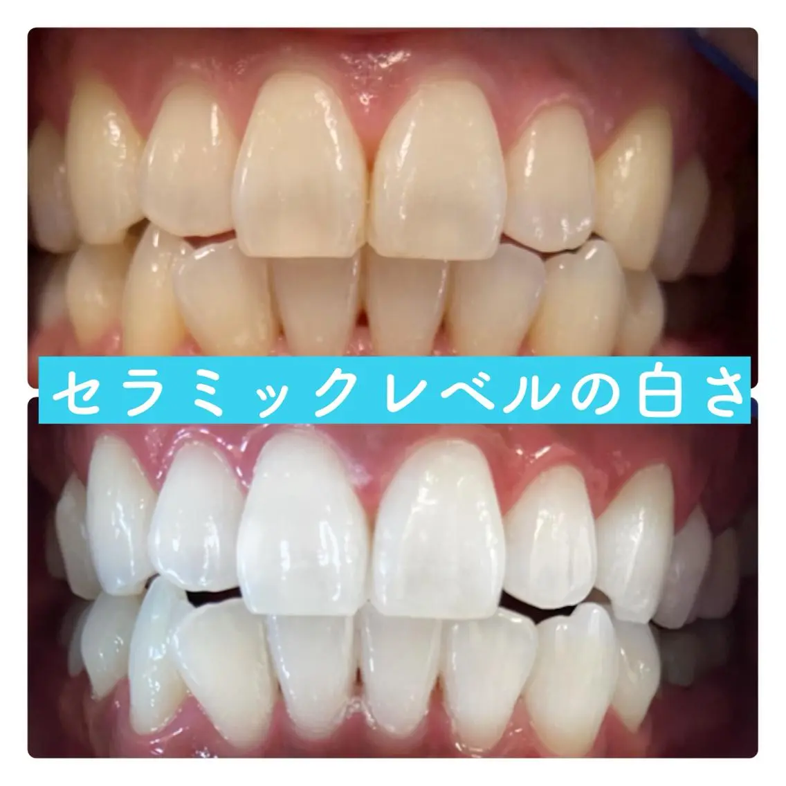 【人気no.1メニュー】ご新規様限定🔥初回体験➕5回来店分チケット🔥白さお約束❣️これで誰でも真っ白な歯に🦷💎の写真