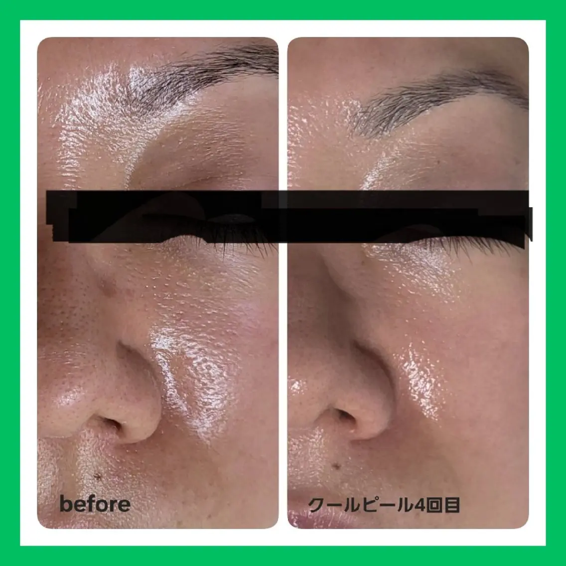毛穴ケア・毛穴引締&トーンUP✨ダウンタイムなしのピーリング+レチノール +ビタミンCイオン導入🫧 1回9,000円の写真