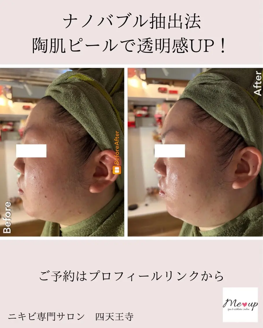 エステ Meupニキビ専門店 背中/ハーブ/肌管理のその他イメージ