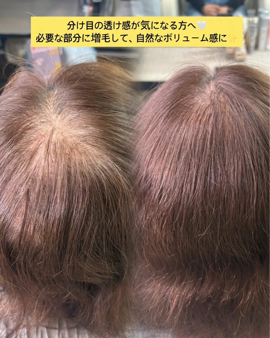 【練習モデル】増毛エクステ500本｜分け目・つむじ・トップのボリュームアップの写真