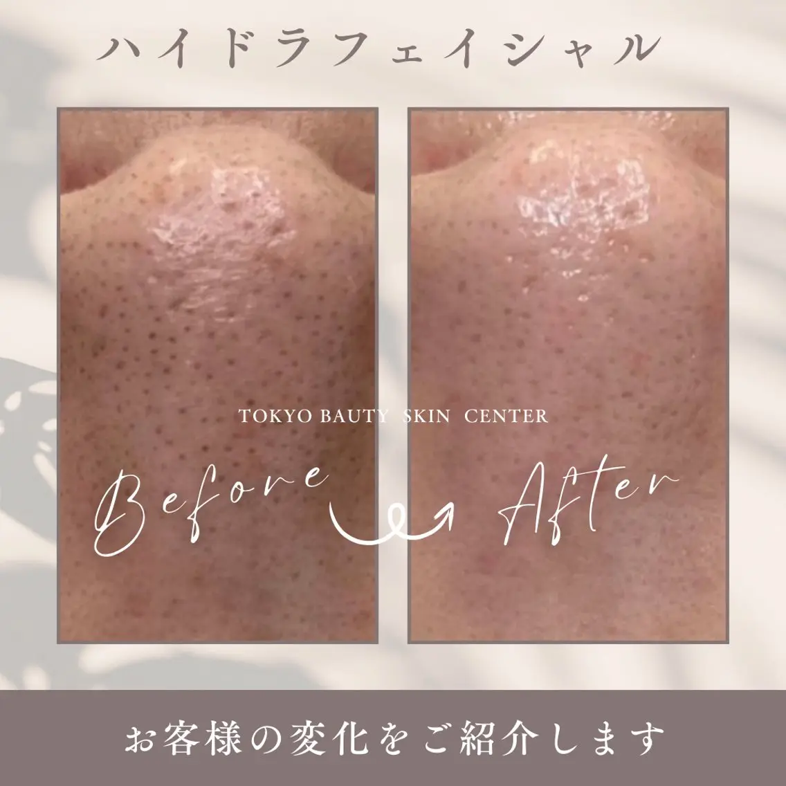 【毛穴詰まりザラザラいちご鼻】ウォーターピーリング毛穴洗浄フェイシャル&美白潤いチャージパック&LEDコラーゲンマシン✨の写真