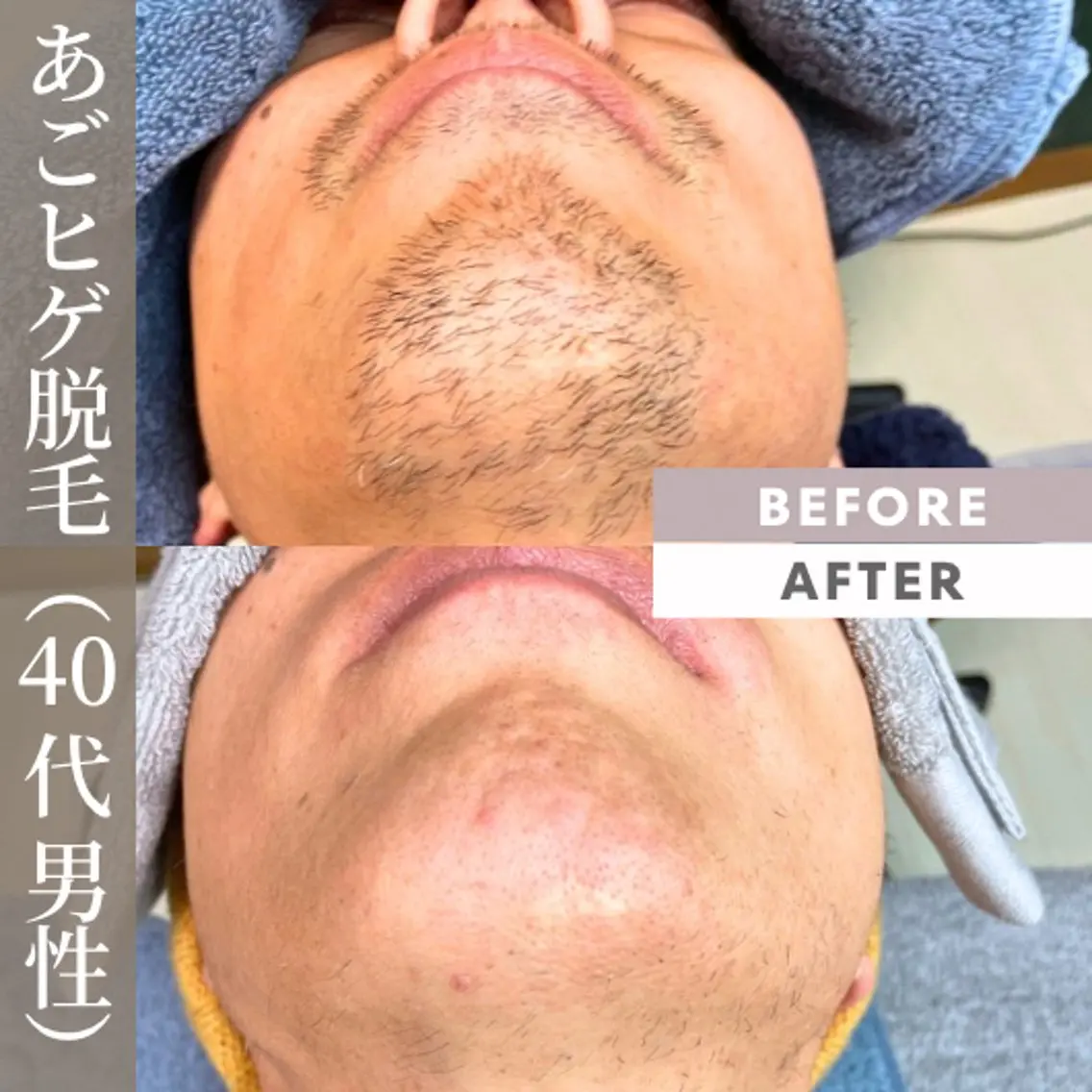 メンズ 脱毛 【一本ずつ脱毛】 ReMove 柏のエステ・リラクイメージ