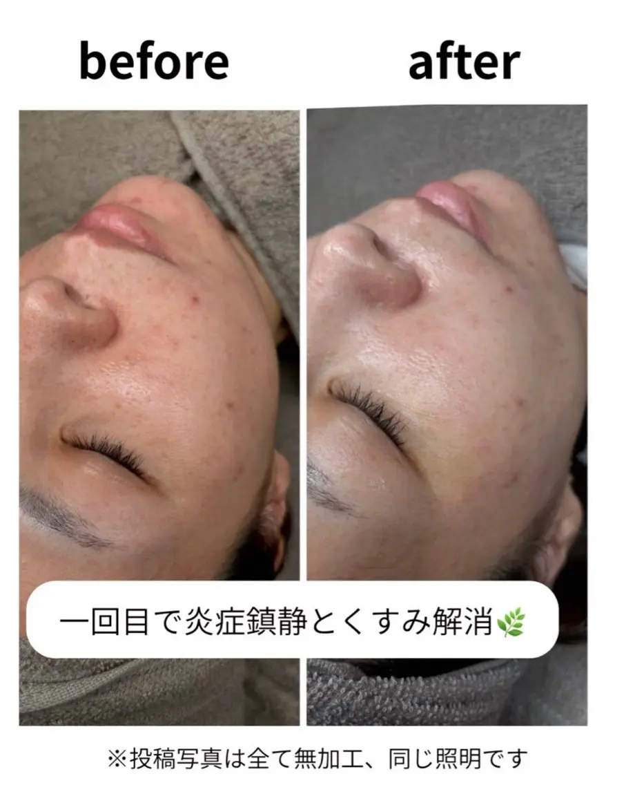 エステダーマ💉気になる肌荒れ💭ニキビを鎮静🌿メンズ◎の写真