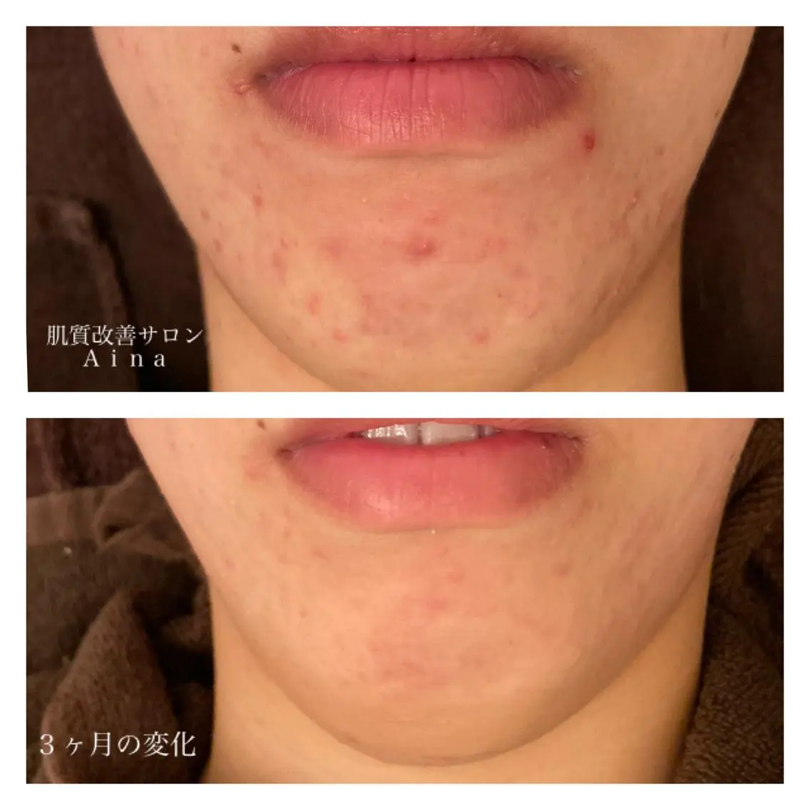 ロング カラー パーマ ヘアアレンジ メンズ キッズ ネイル マツエク・マツパ エステ リラク ニキビ跡専門サロン Ainaのエステ・リラクイメージ