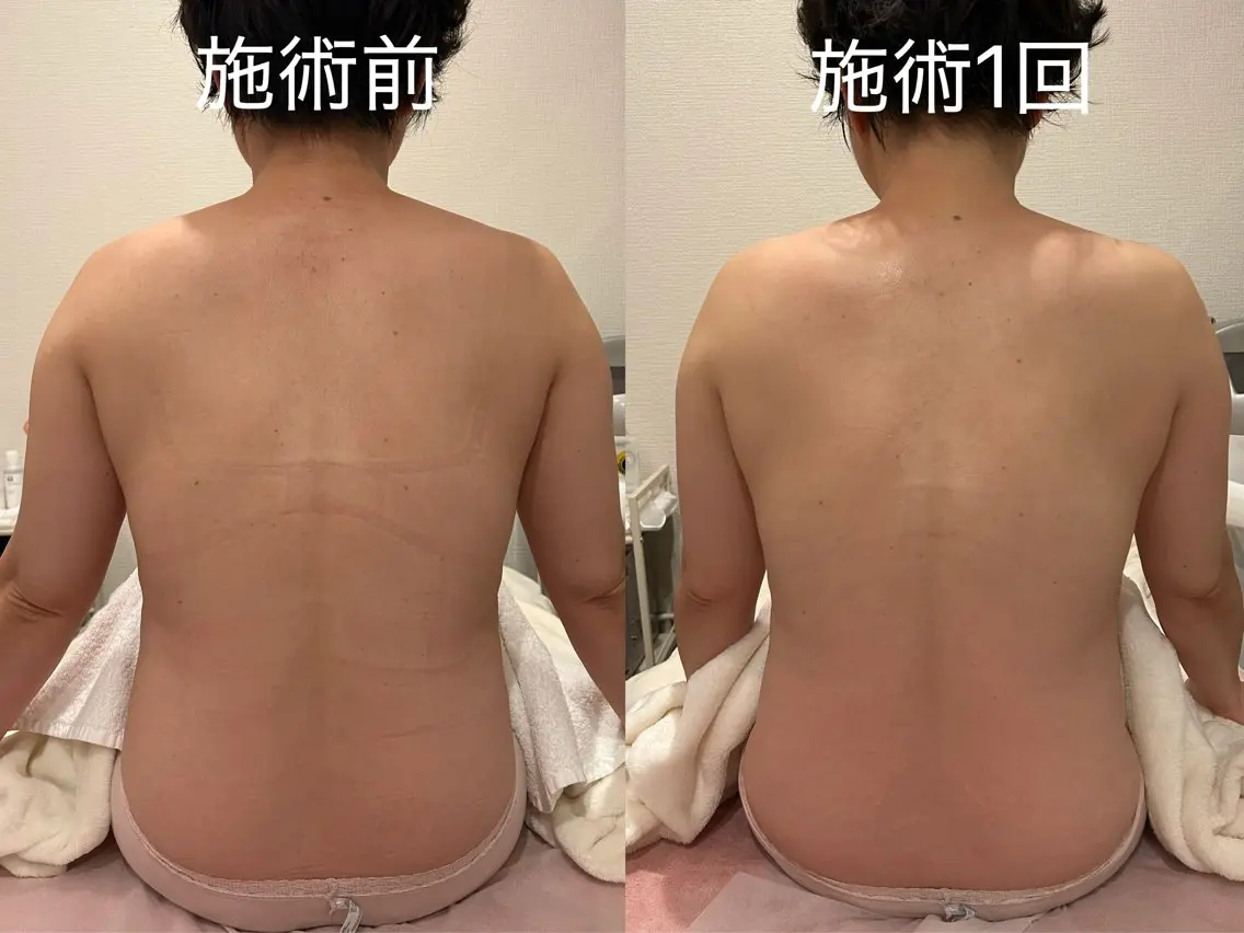 【デトックス痩身】リンパケア 60分（背面＆デコルテ）の写真