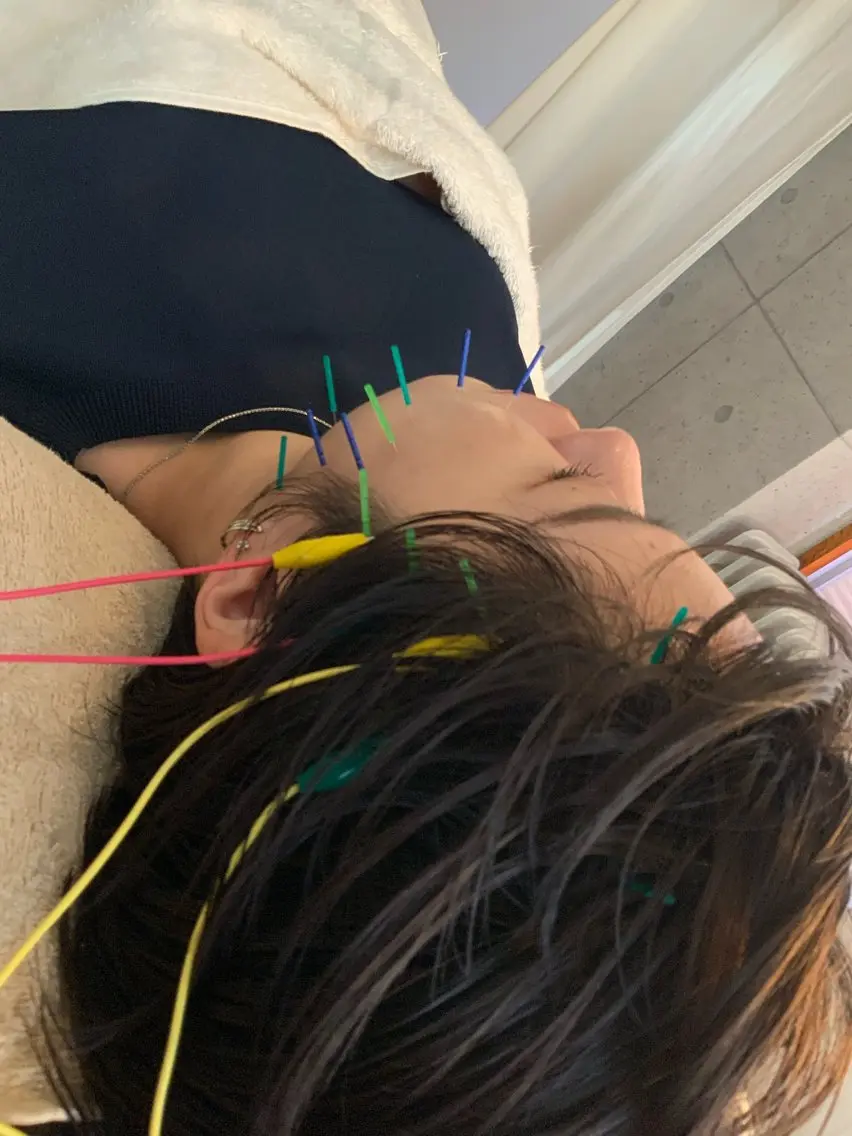 【★衝撃リフトアップ】小顔＆美肌美容鍼灸 30分の写真