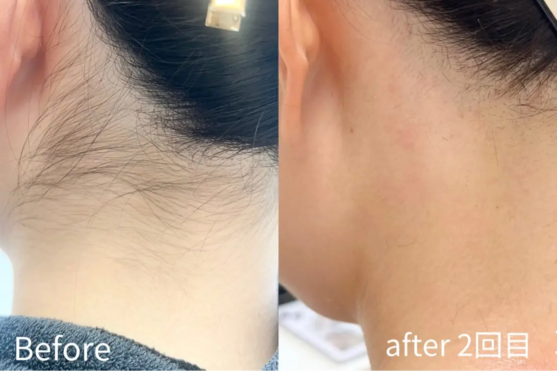 脱毛 Balance facialのエステ・リラクイメージ