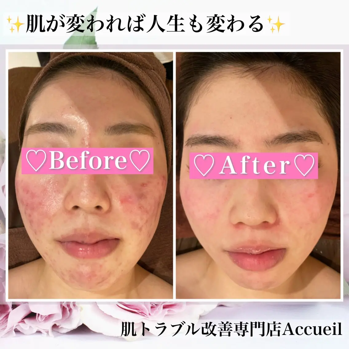 エステ リラク ニキビ・肌質改善専門 ♡人生が変わるサロンのエステ・リラクイメージ