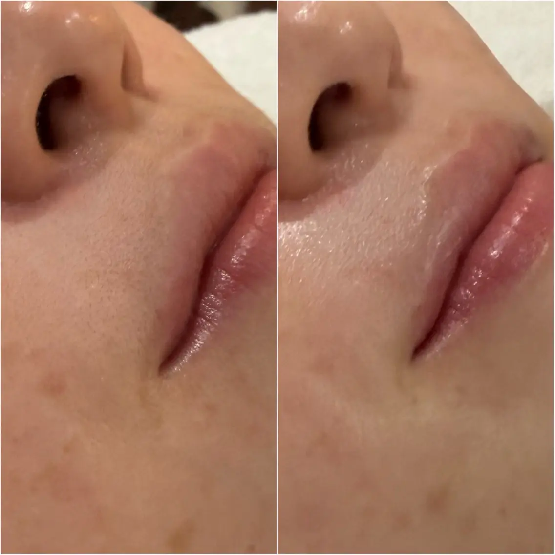 【口周りワックス】の写真