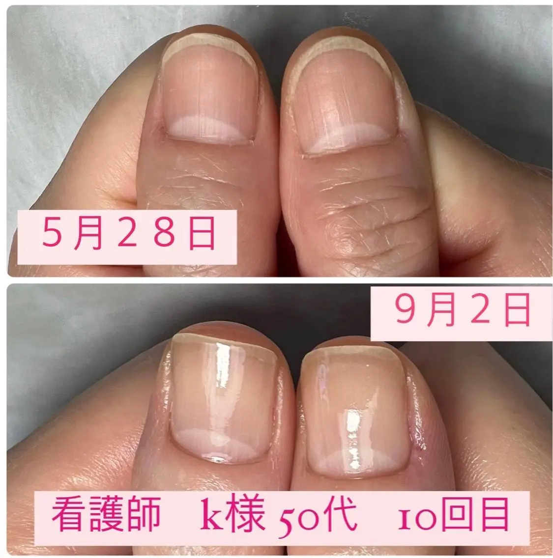ネイル 自爪育成/深爪矯正 mikiのネイルデザイン