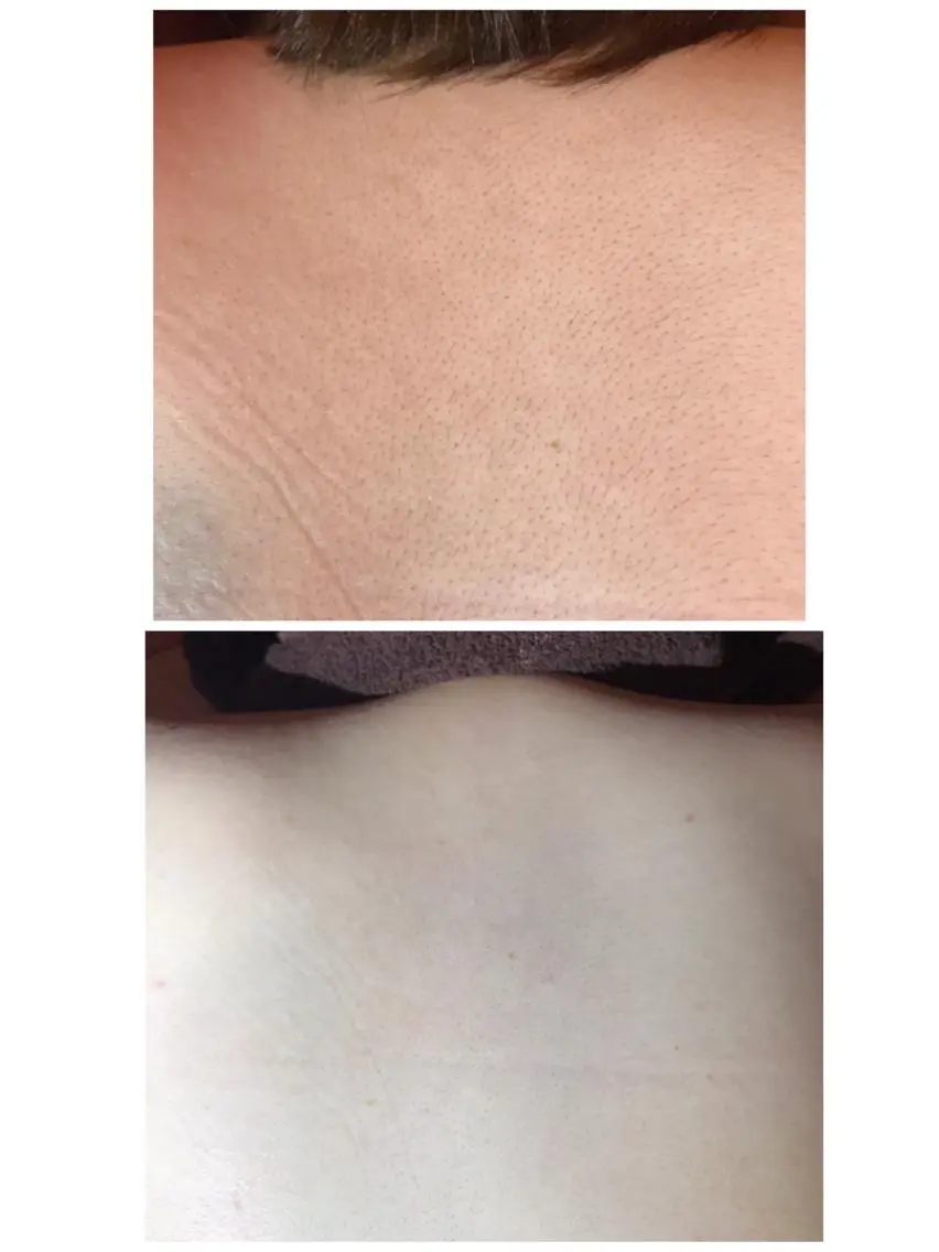 【女性wax】背中FULL ワックス脱毛の写真