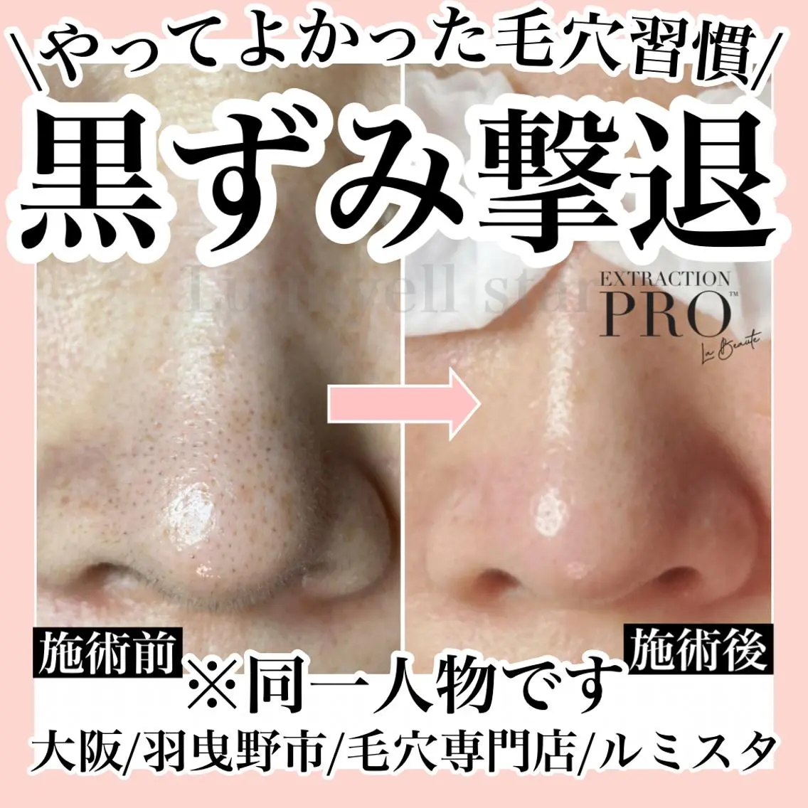 最速 毛穴シミ改善 いくえのその他イメージ