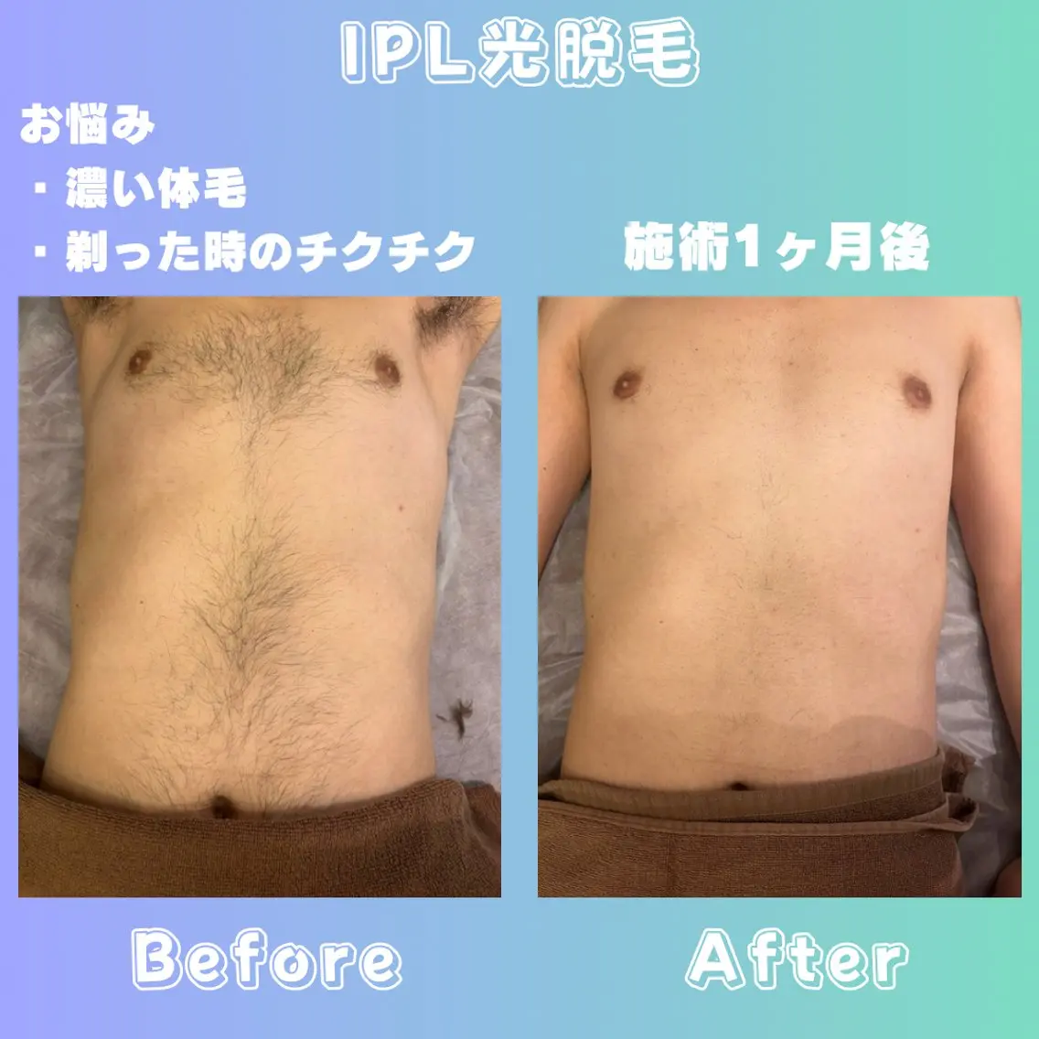 初回で驚きの効果★メンズ全身脱毛★顔VIO込光の効果でくすみぶっ飛び。お顔のニキビ跡にも◎の写真