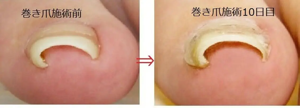巻爪矯正(プレート)の写真