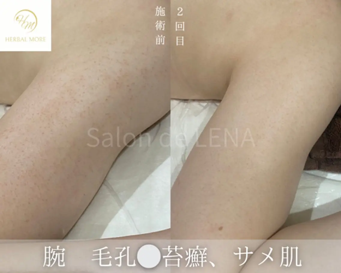 【腕ハーブピーリング/剥離有・無】の写真