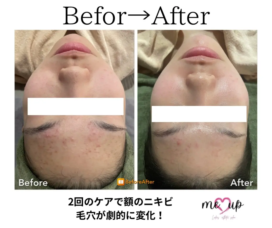 エステ Meupニキビ専門店 背中/ハーブ/肌管理のその他イメージ